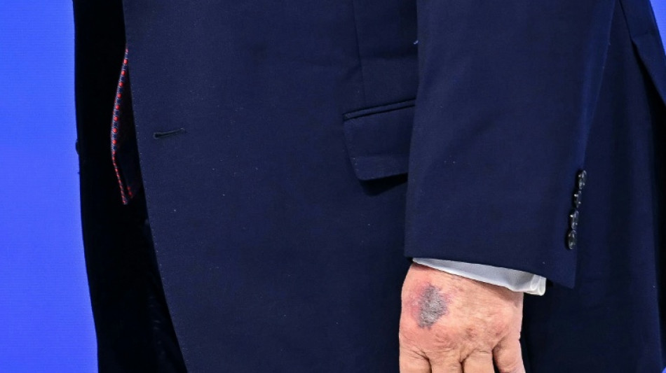 Trump bruised hand on table, he says of new photos